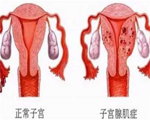 武汉同志试管真实记录：精索静脉曲张下的成功经验与费用